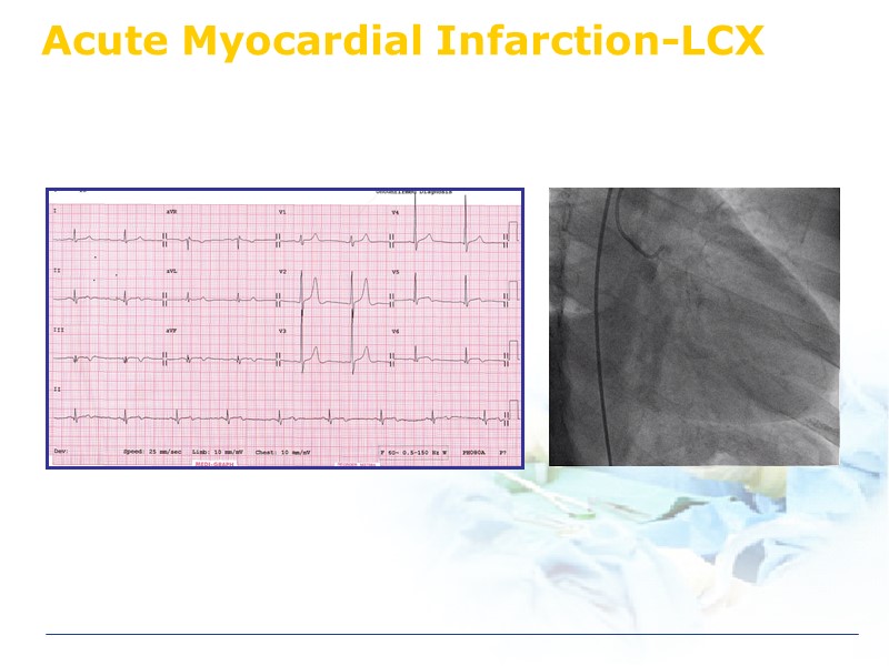 Acute Myocardial Infarction-LCX